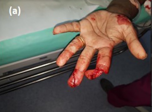 upper-limb-fig4-a