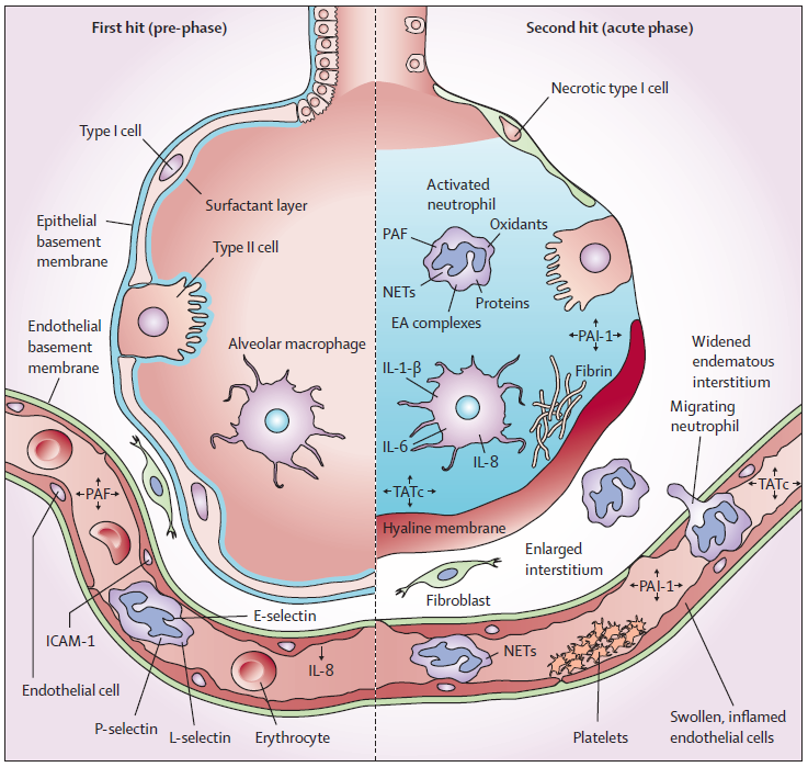 transfusion-related-acute-lung-injury-2