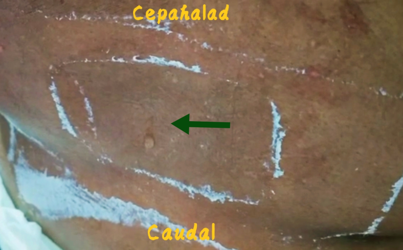 CSF-leak