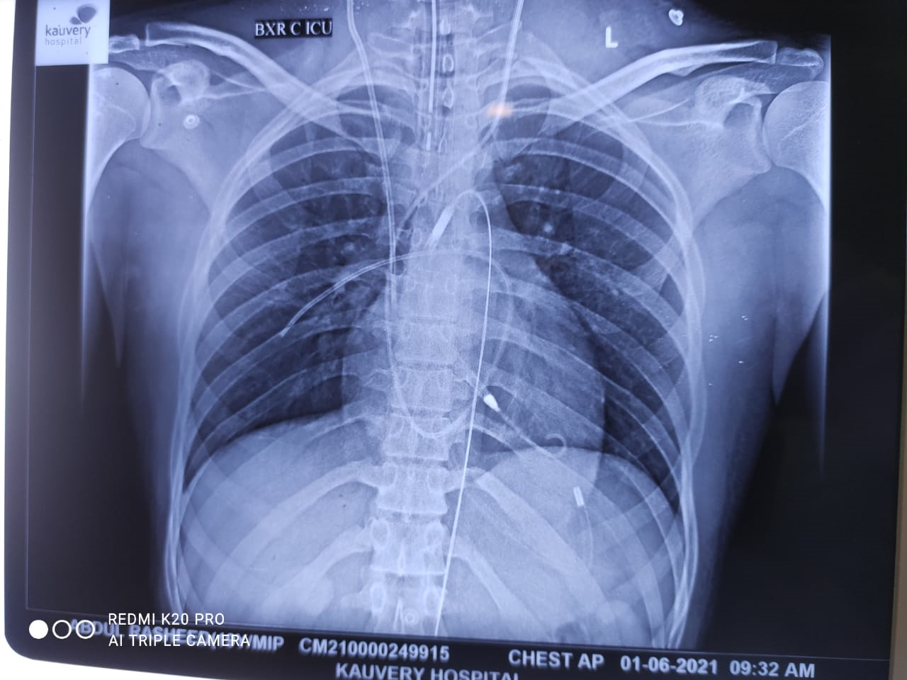 Impella-CP