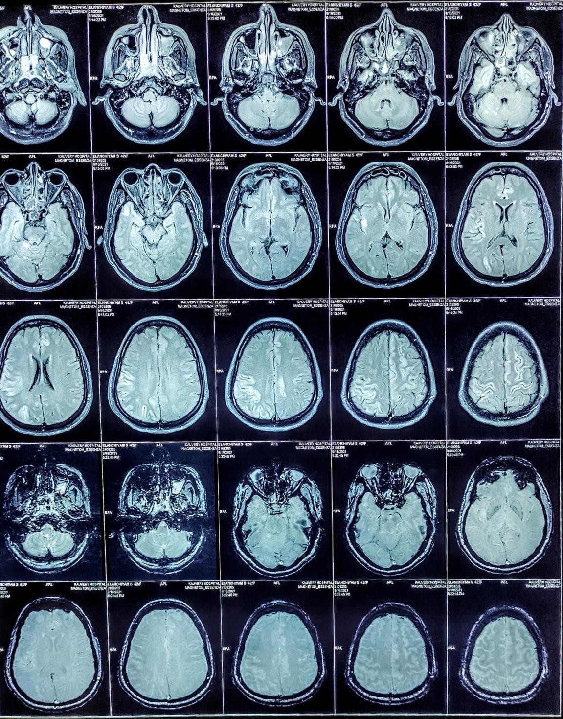 MRI-Brain-3