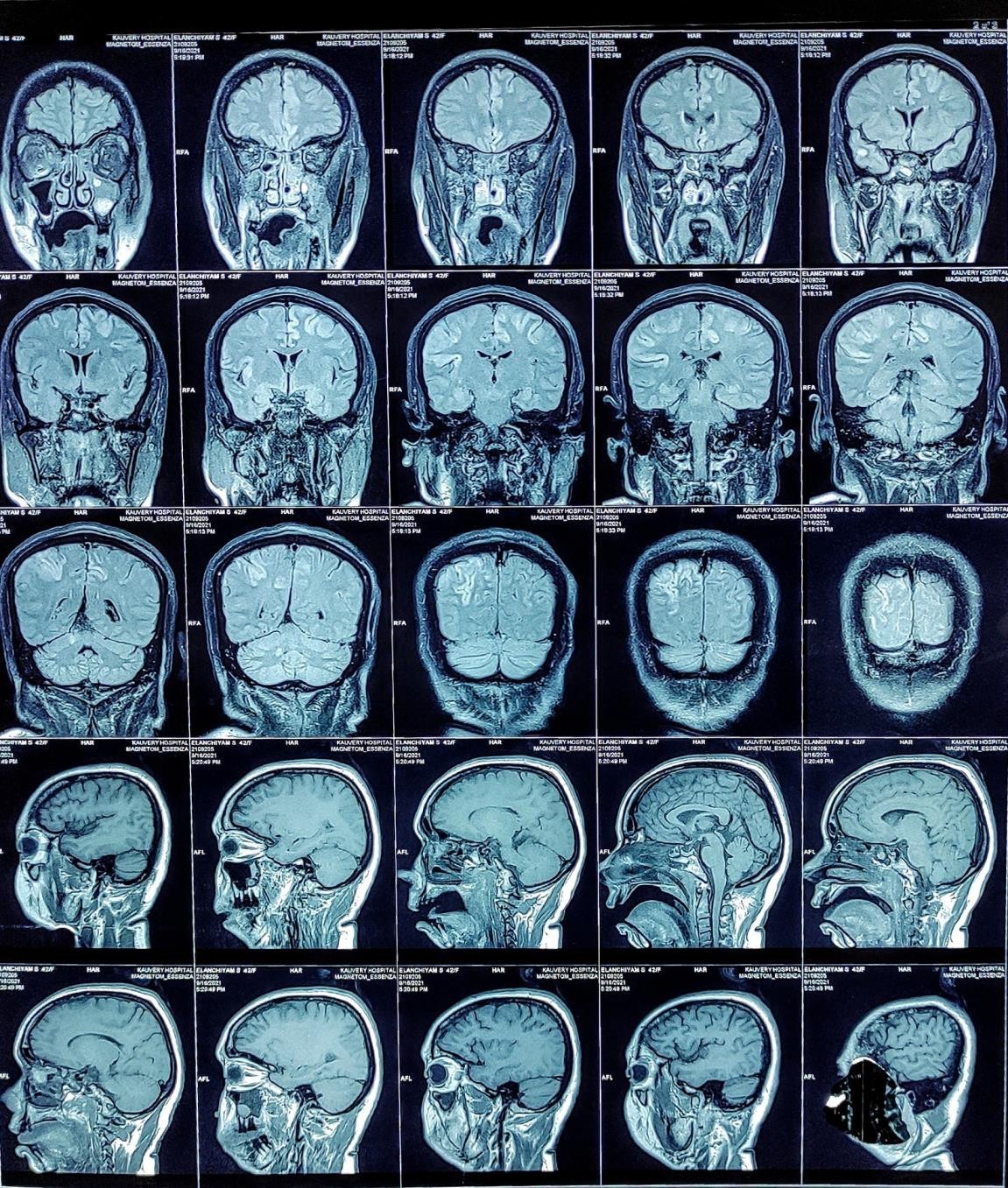 MRI-Brain