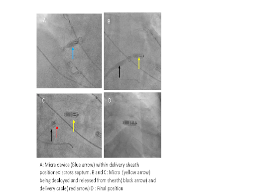 How is a leadless pacemaker implanted?