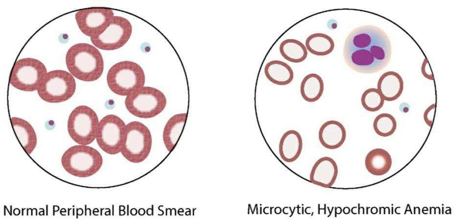 Anaemia-or-Hydrocele-1
