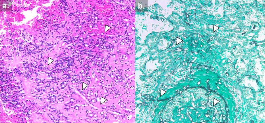 Mucormycosis-10