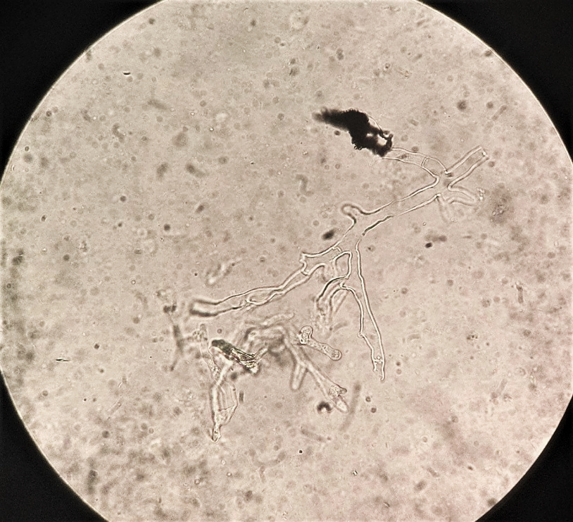 Mucormycosis-11
