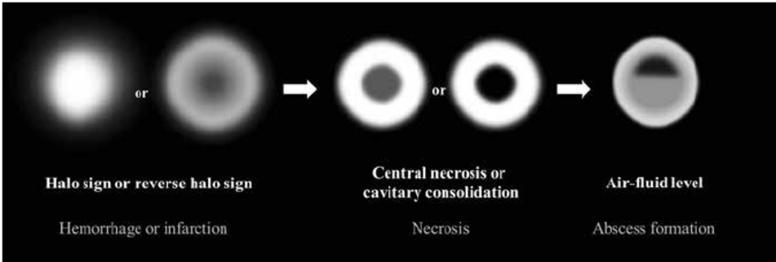 Mucormycosis-8