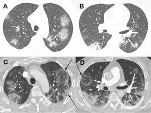 Mucormycosis-9