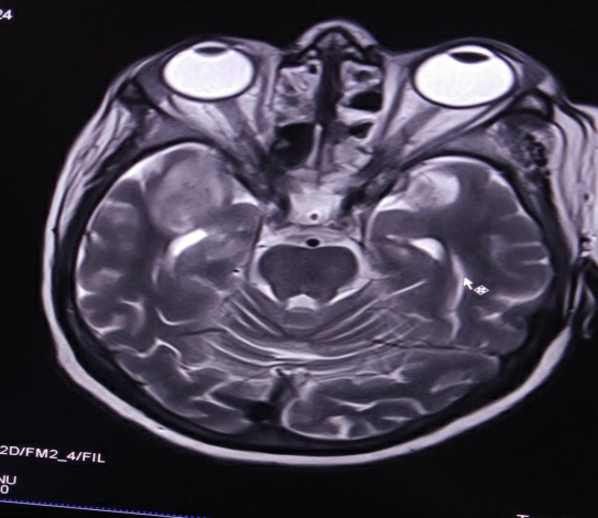 Cavernous-Sinus-Thrombosis