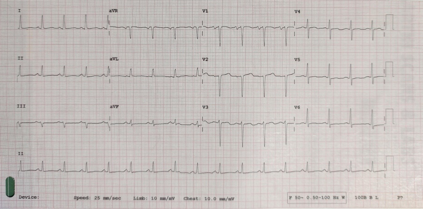 ECG-changes