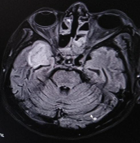 temporal-lobe