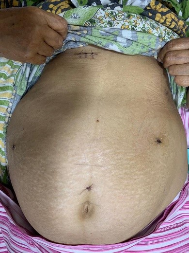 Liver-Cyst-4