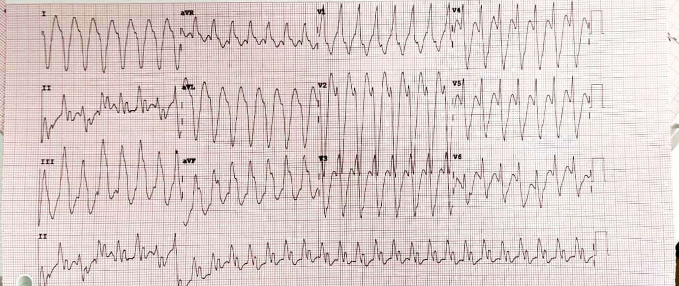 A-Racing-Heart-Beat-1