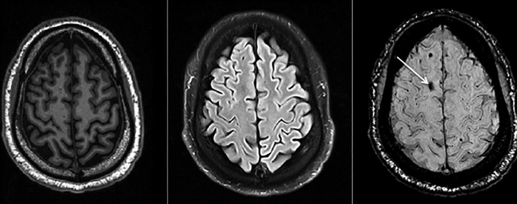 Amnesia-3