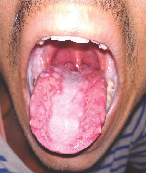 Survival-After-Paraquat-Ingestion-1