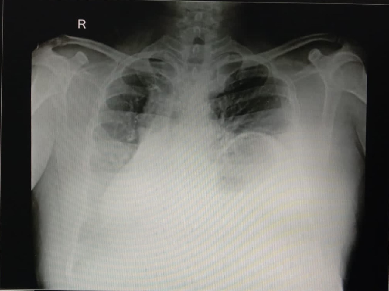 Dextrocardia-2