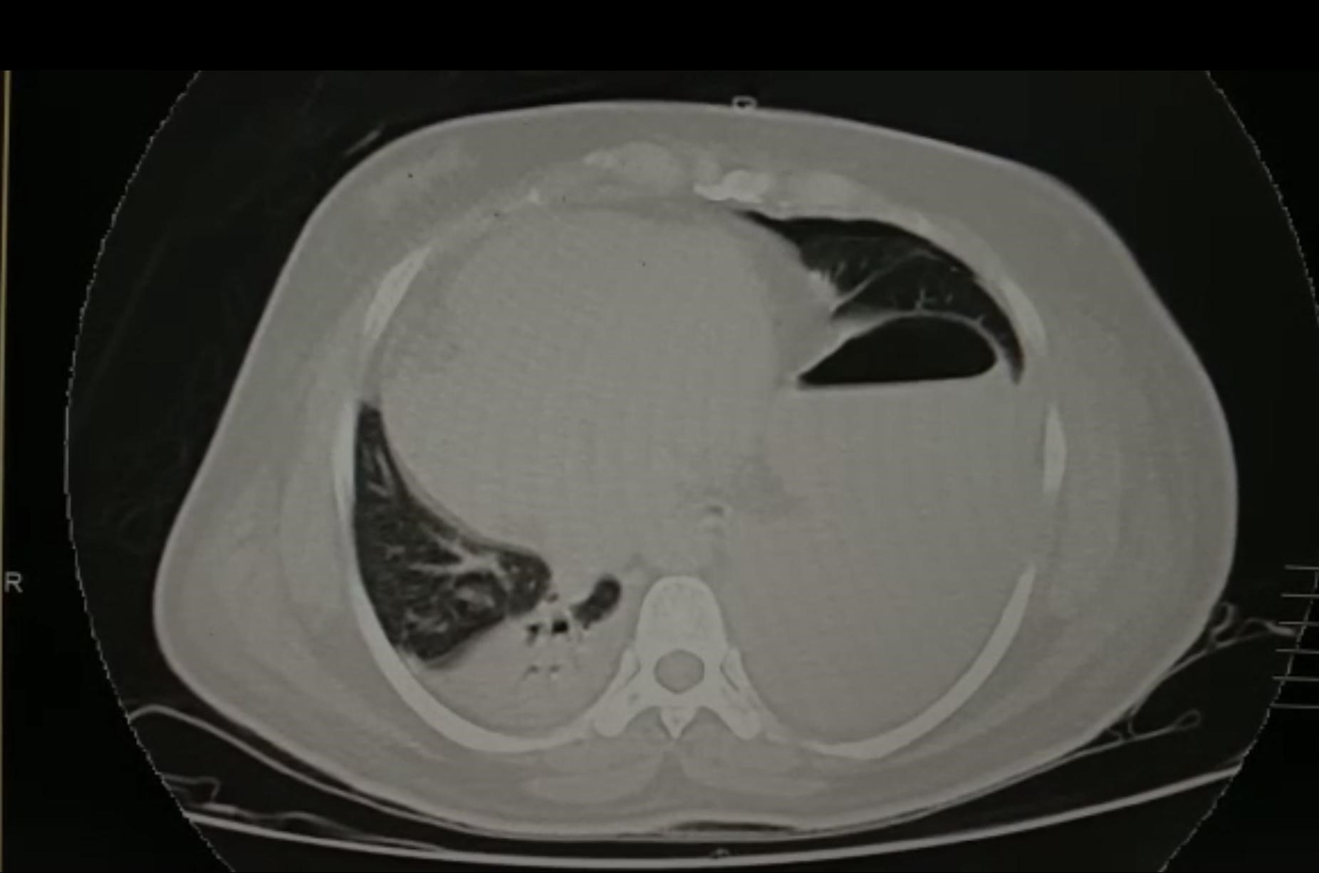 Dextrocardia-5