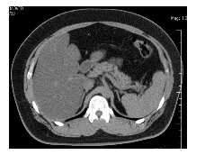 Hypertriglyceridemia-2