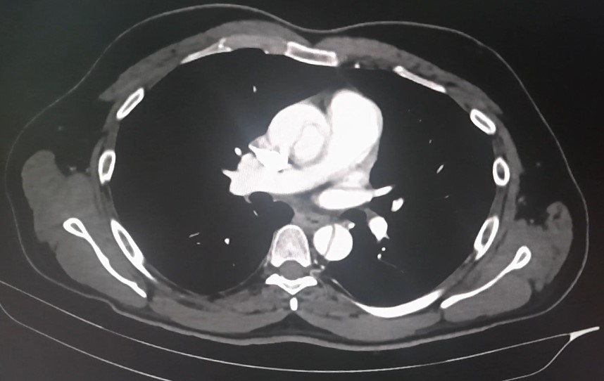 Ischemia-1
