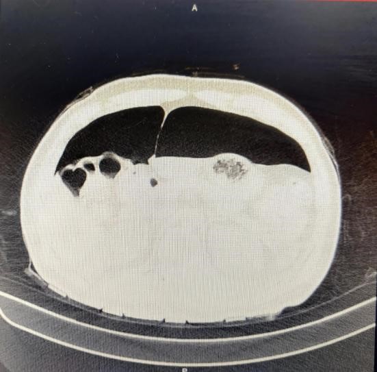Pneumoperitoneum-1