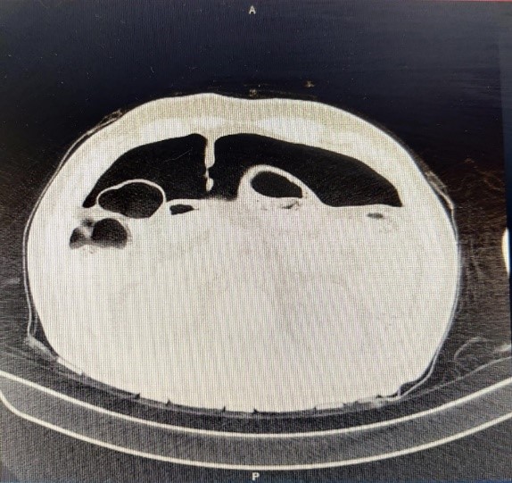 Pneumoperitoneum-2