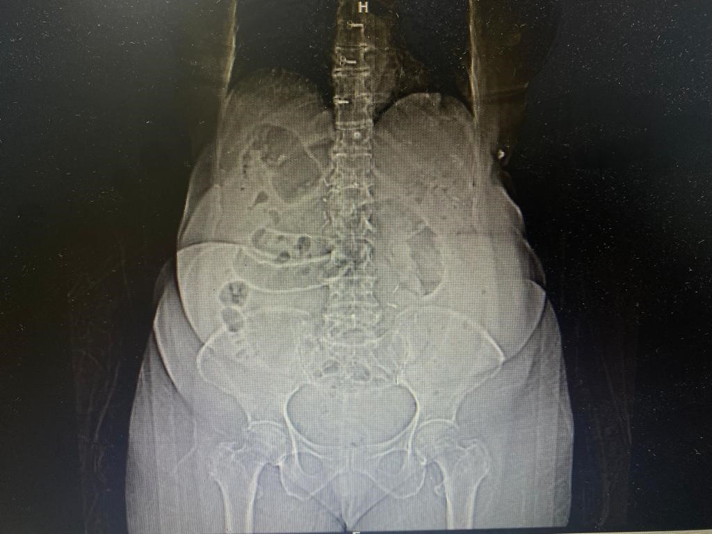 Pneumoperitoneum-4