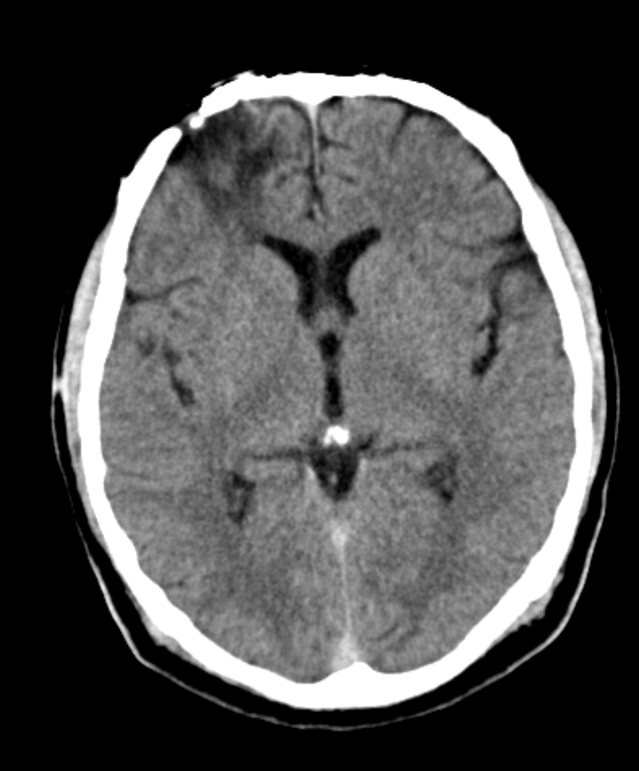 Recognize-Rhabdomyolysis-1