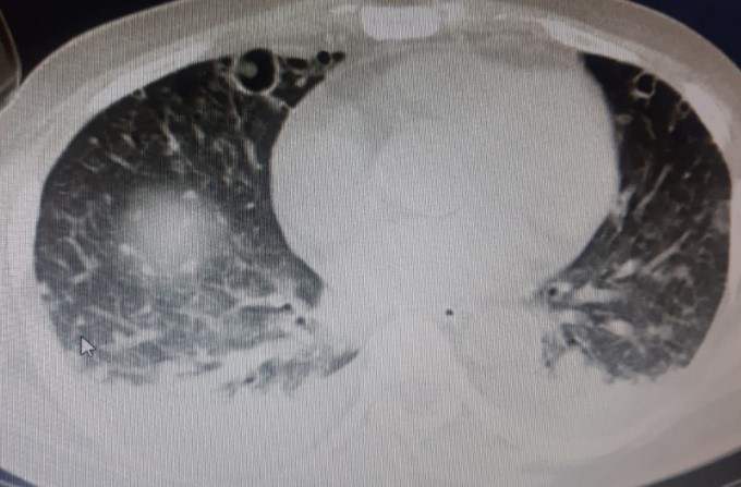 Severe-Meliodosis-1