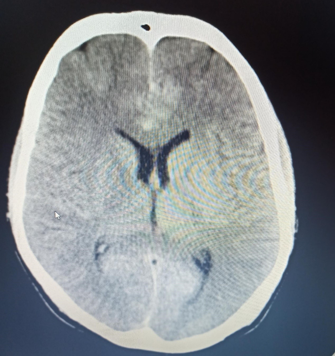 Sub-Arachnoid-Haemorrhage-1