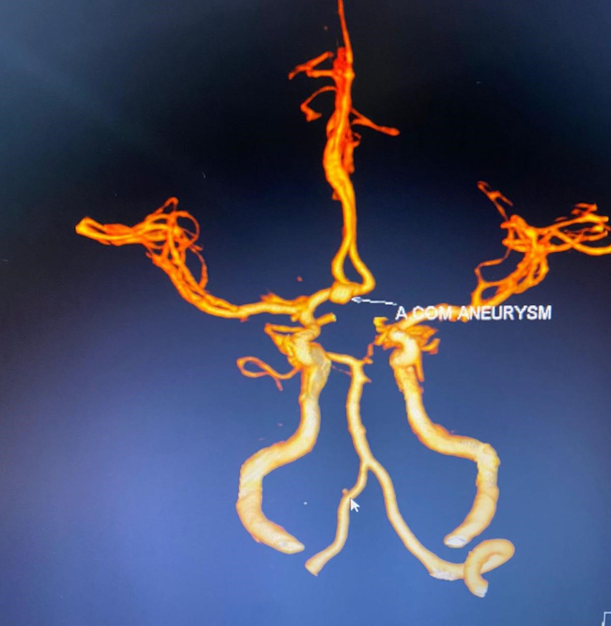Sub-Arachnoid-Haemorrhage-3