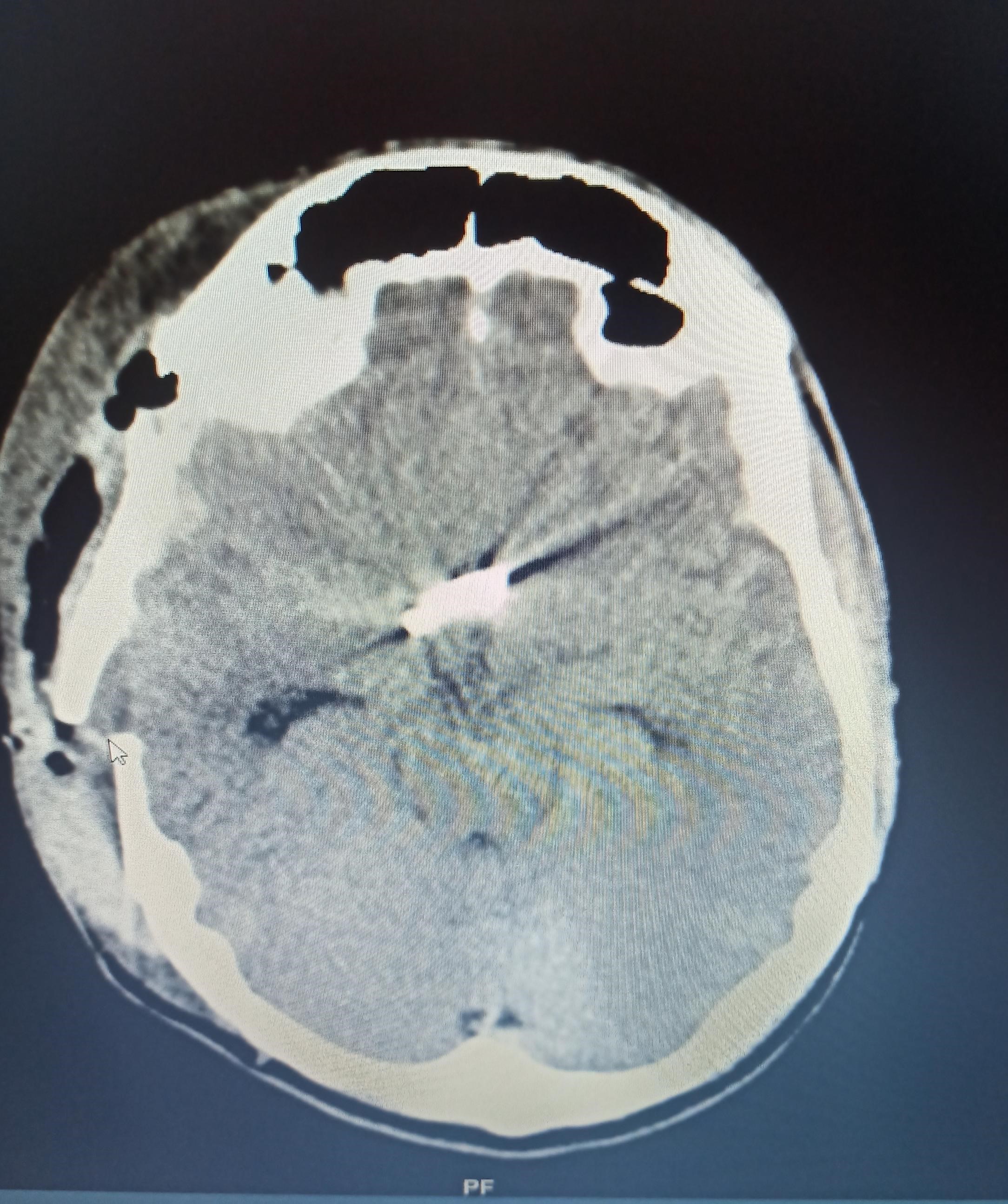 Sub-Arachnoid-Haemorrhage-4