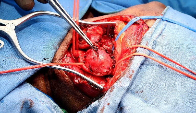 Bilateral-Carotid-aneurysms-3