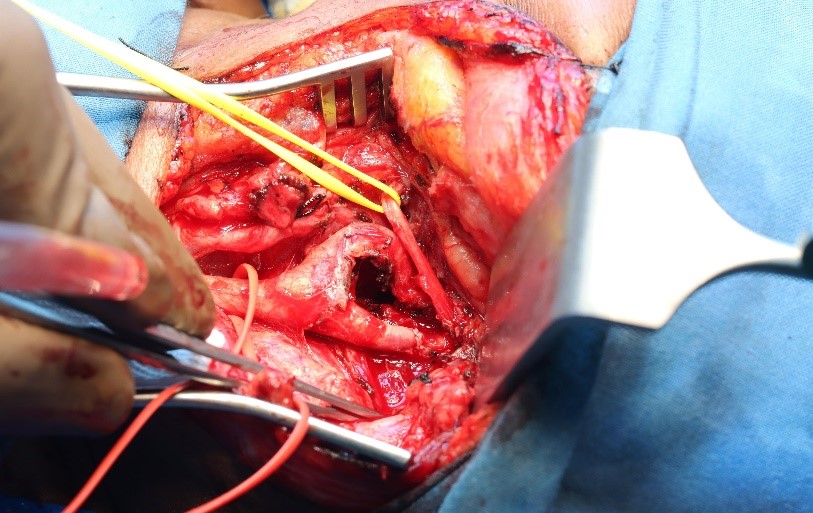 Bilateral-Carotid-aneurysms-6