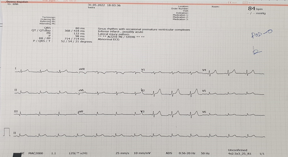 ECG