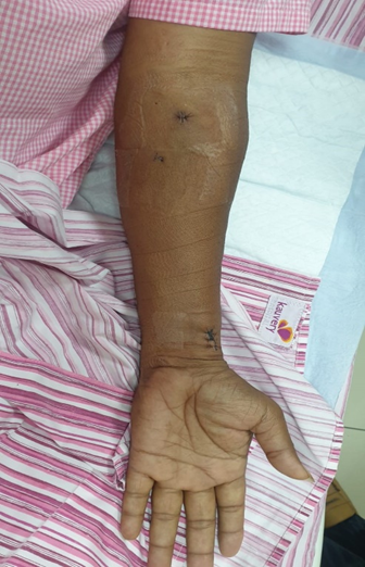 Left-Radial-Artery