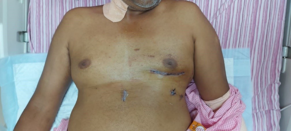 MICS-surgical-scar