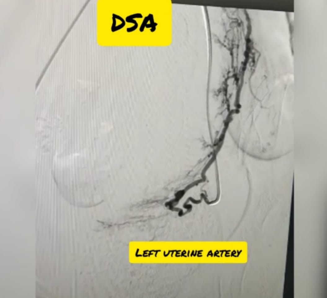 Uterine-artery-embolization-2