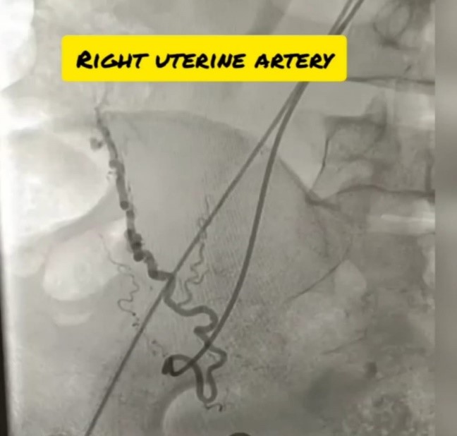 Uterine-artery-embolization-4