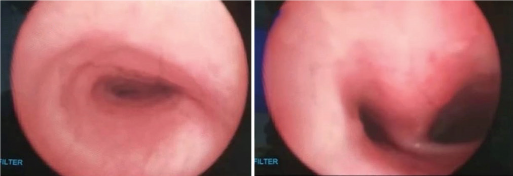 Dynamic-examination-of-airway-2