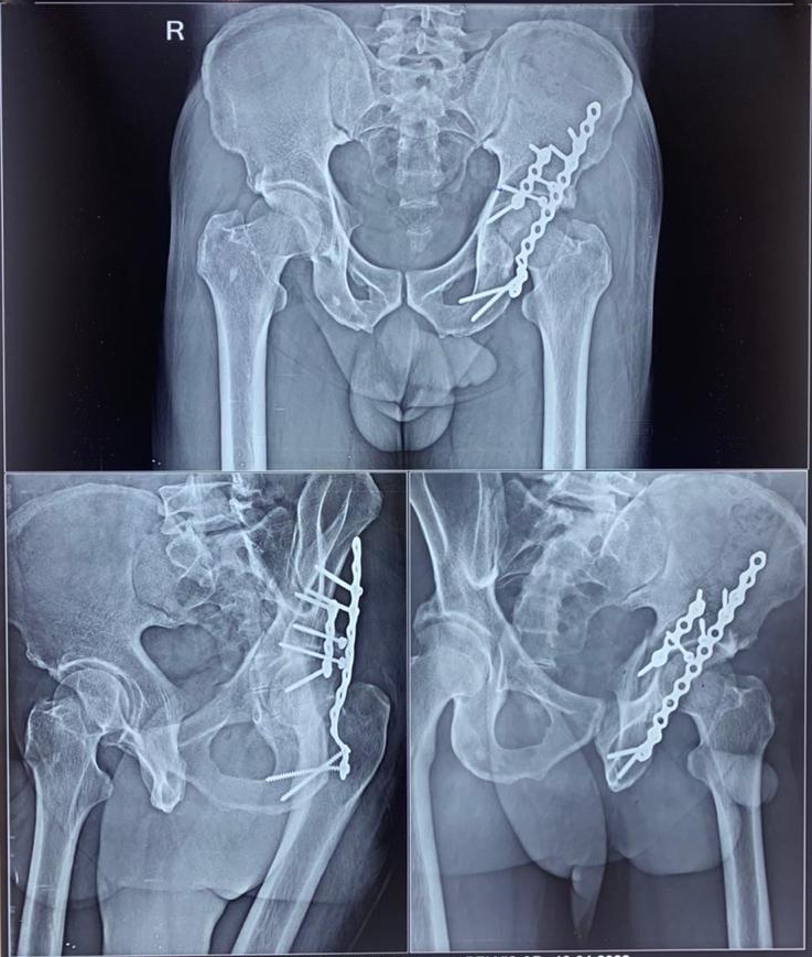 Guillain-Barre-Syndrome-3