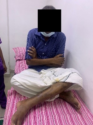 Guillain-Barre-Syndrome-4