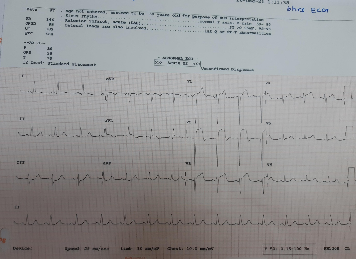 ECG-post-6-of-lysis