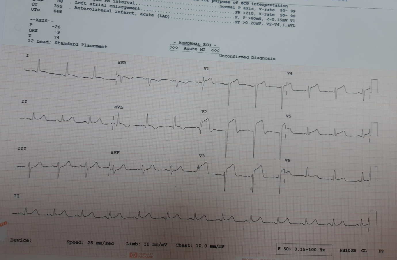 ECG