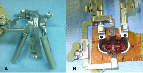 Minimally-invasive-surgery-4