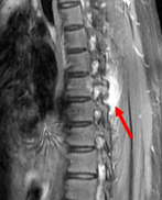 Minimally-invasive-surgery-7