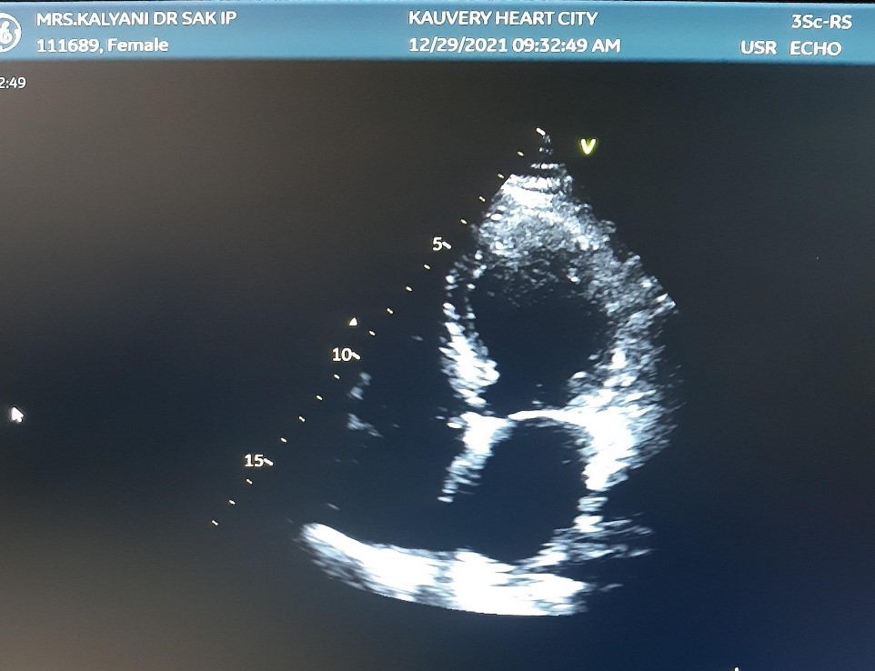 Takotsubo-cardiomyopathy-2