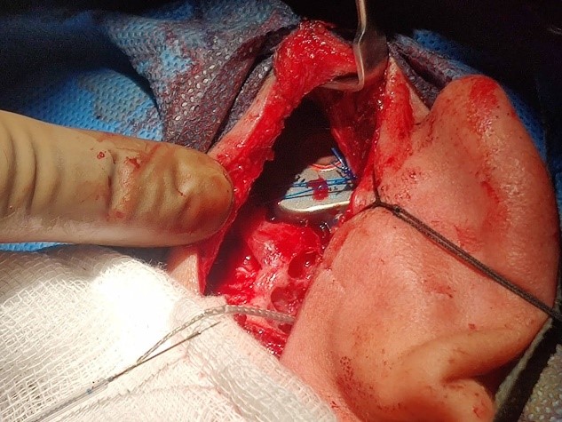 Cochlear-Implantation-1