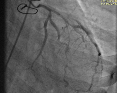 ECMO-IABP-2
