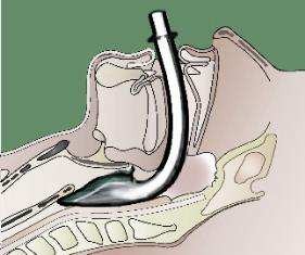 LMA-in-Obese