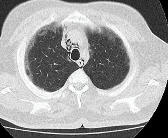 Spontaneous-Pneumomediastinum-1